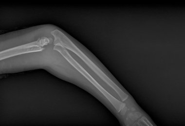 kırık kol xray