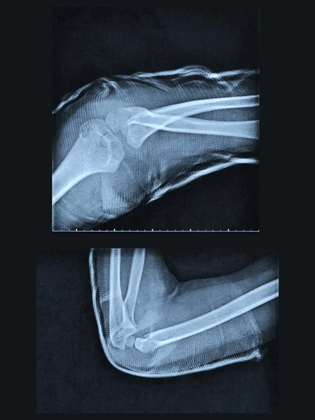 Röntgenbild gebrochener Arm — Stockfoto