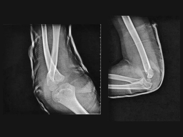 Kırık kol xray — Stok fotoğraf