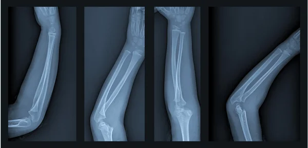 kırık kol xray