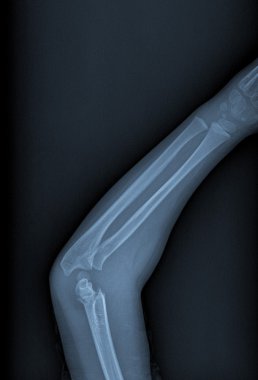 kırık kol xray