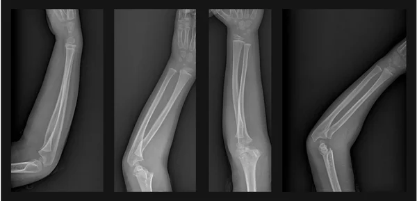 Złamane ramię xray — Zdjęcie stockowe