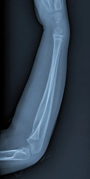 Zlomená ruka xray — Stock fotografie