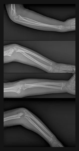 Kırık kol xray — Stok fotoğraf