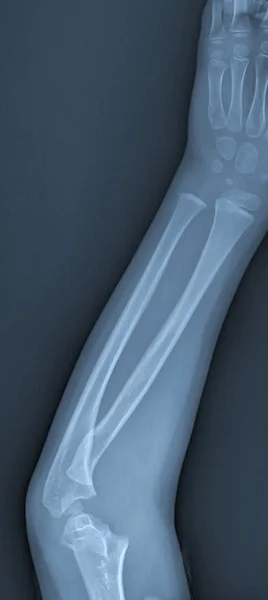 Röntgenbild gebrochener Arm — Stockfoto