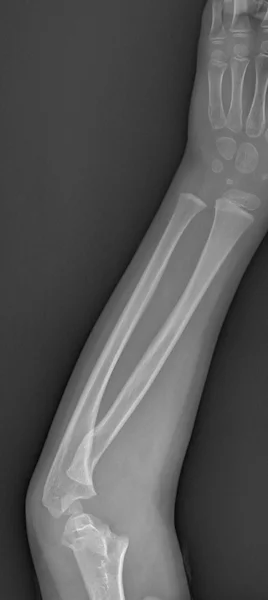 Bruten arm xray — Stockfoto