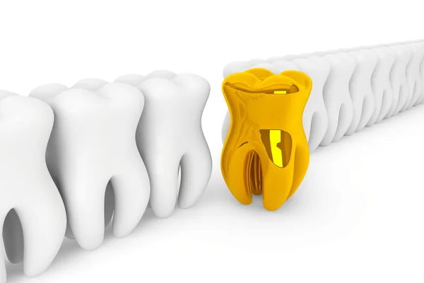 Extremo close up dente de ouro — Fotografia de Stock