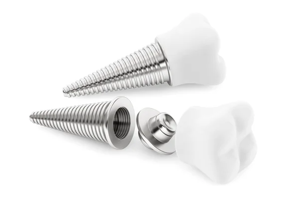 Dental concept. Tooth Implant — Stock Photo, Image