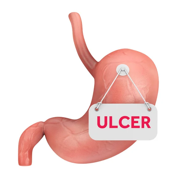 Anatomia Estômago Humano Órgão Interno Com Sinal Úlcera Fundo Branco — Fotografia de Stock
