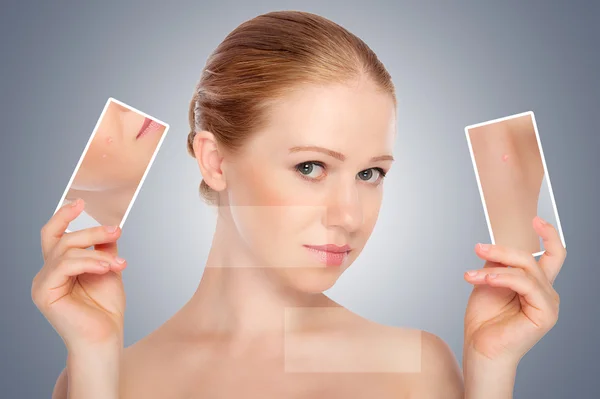 Concepto cuidado de la piel. Piel de mujer joven belleza con acné —  Fotos de Stock