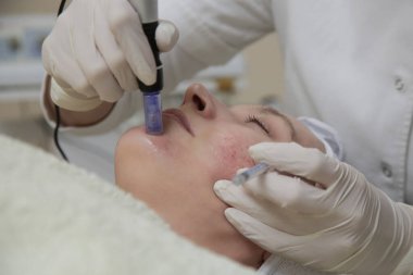 Mezoterapi. Kadın cilt bakımı yaptırıyor. Dermatologda mikro iğne kozmetik tedavisi görüyor..