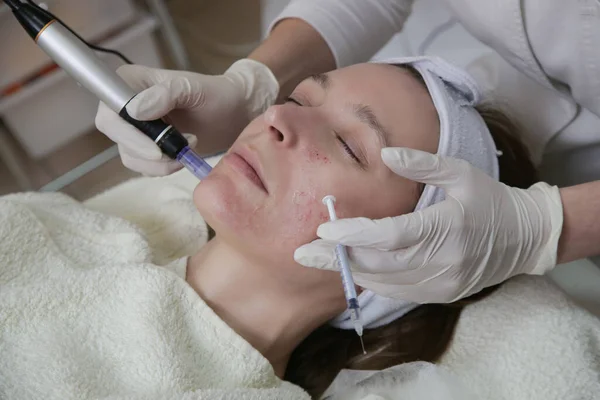 Mesoterapia Mujer Que Tiene Dermapen Tratamiento Facial Micro Aguja Tratamiento —  Fotos de Stock