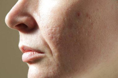 Extreme close-up of texture of problematic human skin with large-looking open pores, acne scars  and nasolabial fold clipart