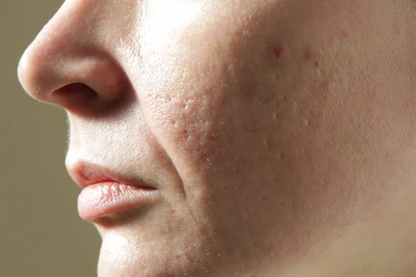 問題のある人間の皮膚の質感の極端なクローズアップ大規模な外観の開いている毛穴 にきび跡や鼻腔内の折り目 — ストック写真