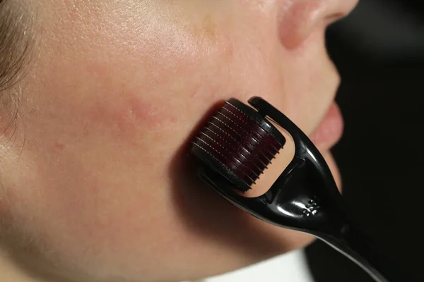 Massaggio Viso Con Dermaroller Microneedle Trattamento Cicatrici Rughe Ringiovanimento Del — Foto Stock