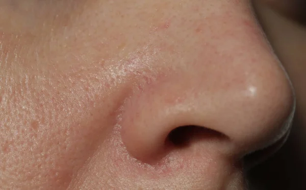 Extreme Nahaufnahme Der Textur Problematischer Menschlicher Haut Mit Groß Aussehenden — Stockfoto