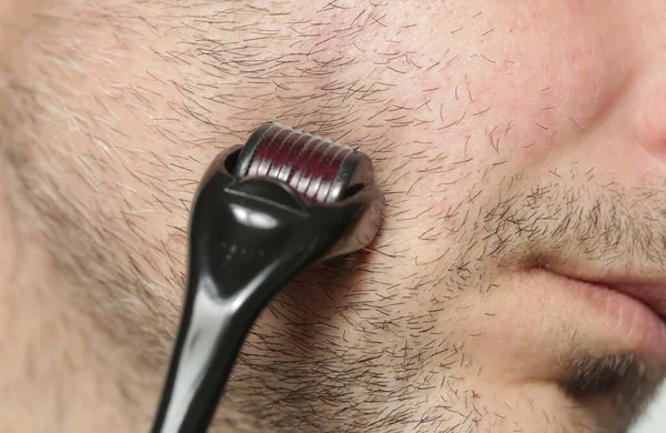 Gesichtsmassage Mit Mikronadeln Dermaroller Zur Behandlung Von Narben Falten Und — Stockfoto