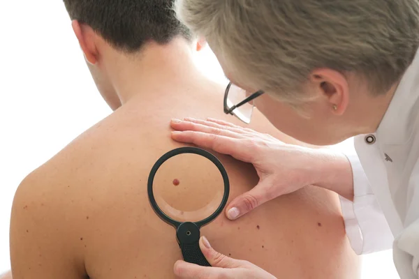 Dermatologista examina uma toupeira — Fotografia de Stock