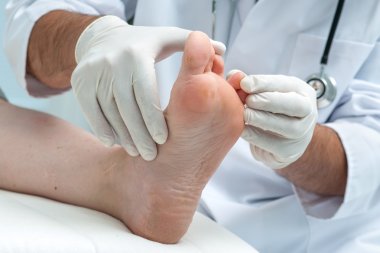 Tinia pedis veya atlet ayak