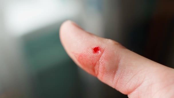 Close Blurred Background Thumb Torn Skin Slight Bleeding Wound Arm — Video Stock