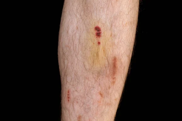 Injured Shin Injuries Bruises Fall — Zdjęcie stockowe