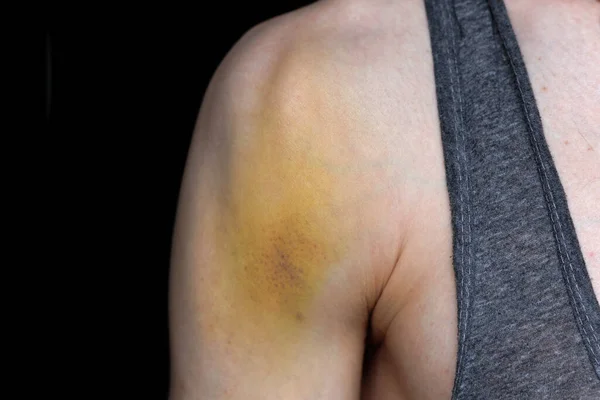 Shoulders Bruises Fall — Fotografie, imagine de stoc