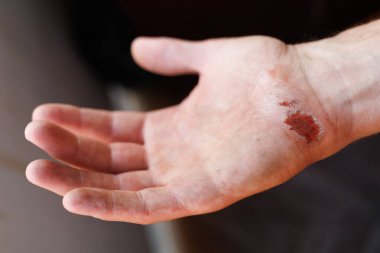 Wound on the palm after a fall. Abraded skin on the hand.