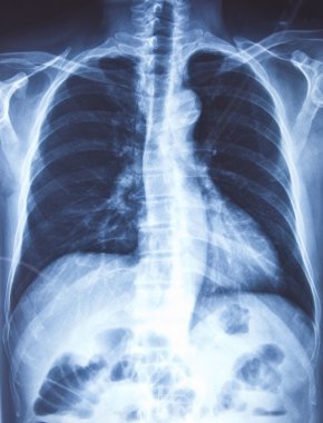 ve göğüs x-ray