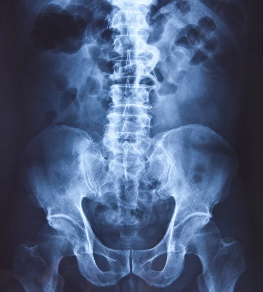 Radiografía de la pelvis y la columna vertebral — Foto de Stock