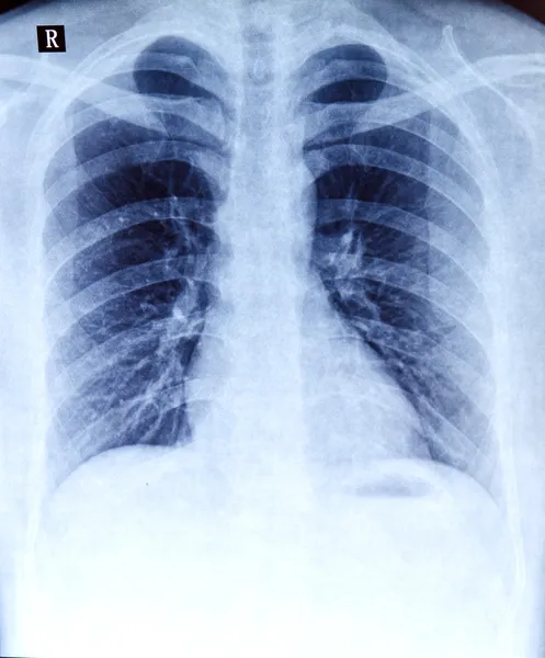 Radiographie pulmonaire Images De Stock Libres De Droits