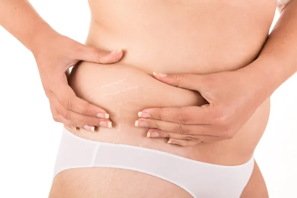 Woman showing her old stretch marks — Stock Photo, Image