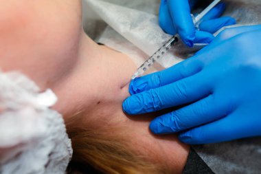 Kadın müşteri, tıbbi estetik kliniğinde köstebek temizleme tedavisinden önce lokal anestezi yaptırıyor.