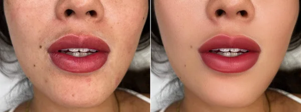 Lips after permanent make-up close-up. Lips of a young woman after augmentation. Filler injection, mesotherapy, correction. Beautiful lip treatment after augmentation before and after.