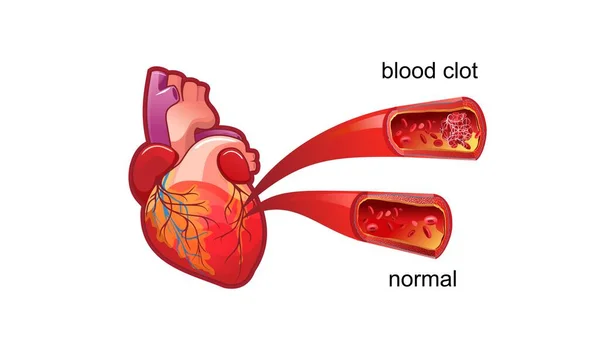 Coágulo de sangre trombo póster médico — Archivo Imágenes Vectoriales