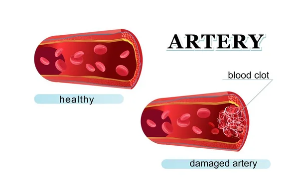 Coágulo de sangre trombo póster médico — Vector de stock