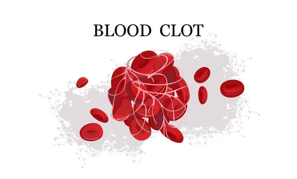 Blood clot thrombus medical poster Stock Vector