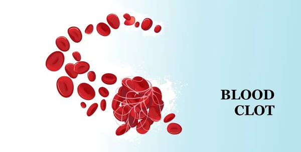 Θρόμβος αίματος ιατρική αφίσα — Διανυσματικό Αρχείο