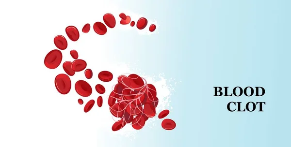 Coágulo de sangre trombo póster médico Ilustraciones de stock libres de derechos