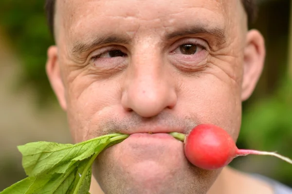 Dawn syndrome man with radish — Stock Photo, Image