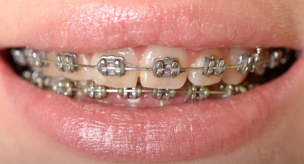 Braces — Stock Photo, Image