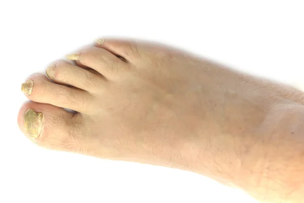 Champignon ongle du pied — Photo