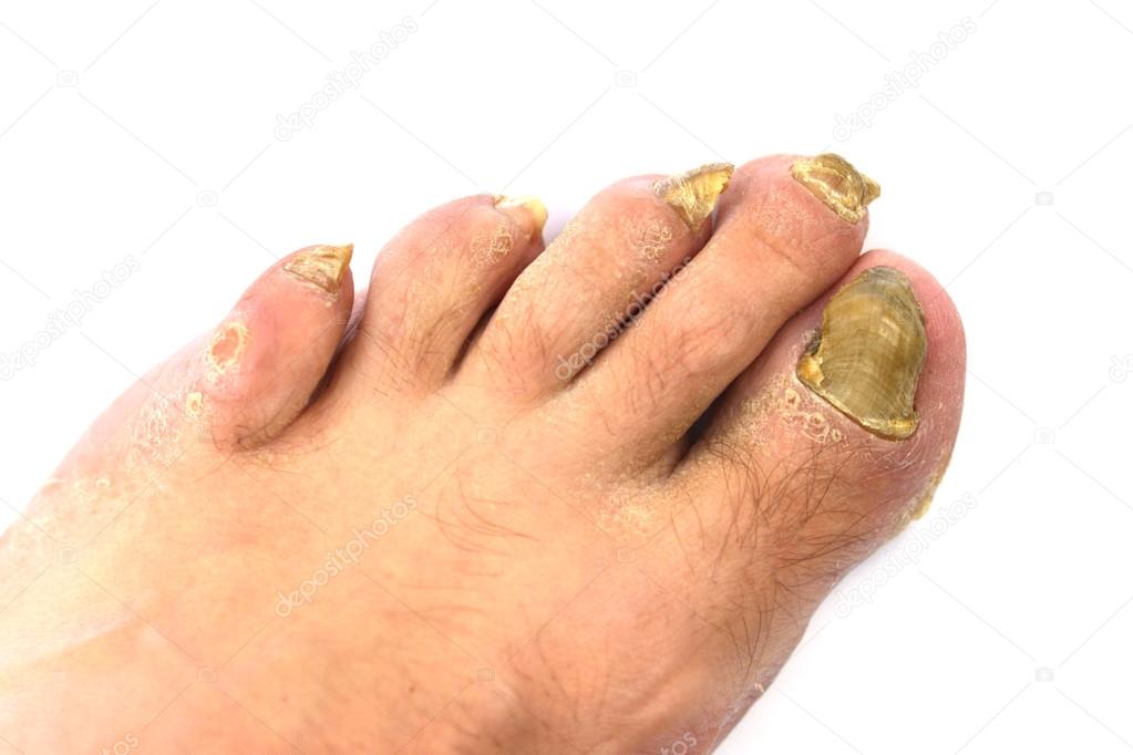 Toenail fungus