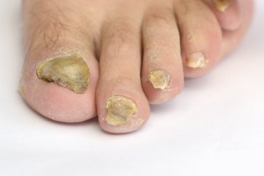 Fungus Infection on Nails clipart