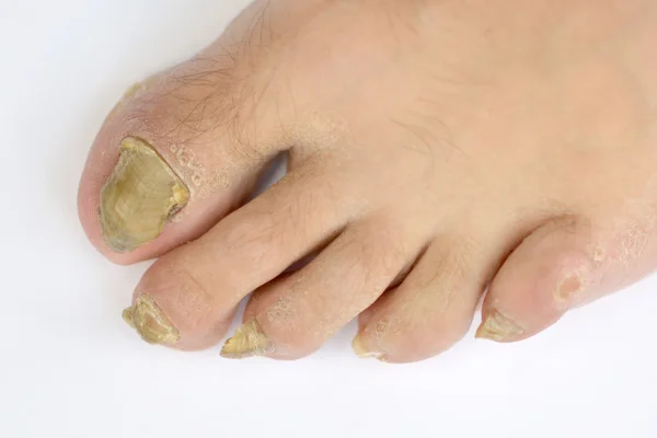 Pilzinfektion auf Nägeln — Stockfoto