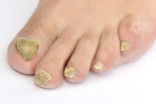 10 Proven Home Remedies to Get Rid of Toenail Fungus Fast