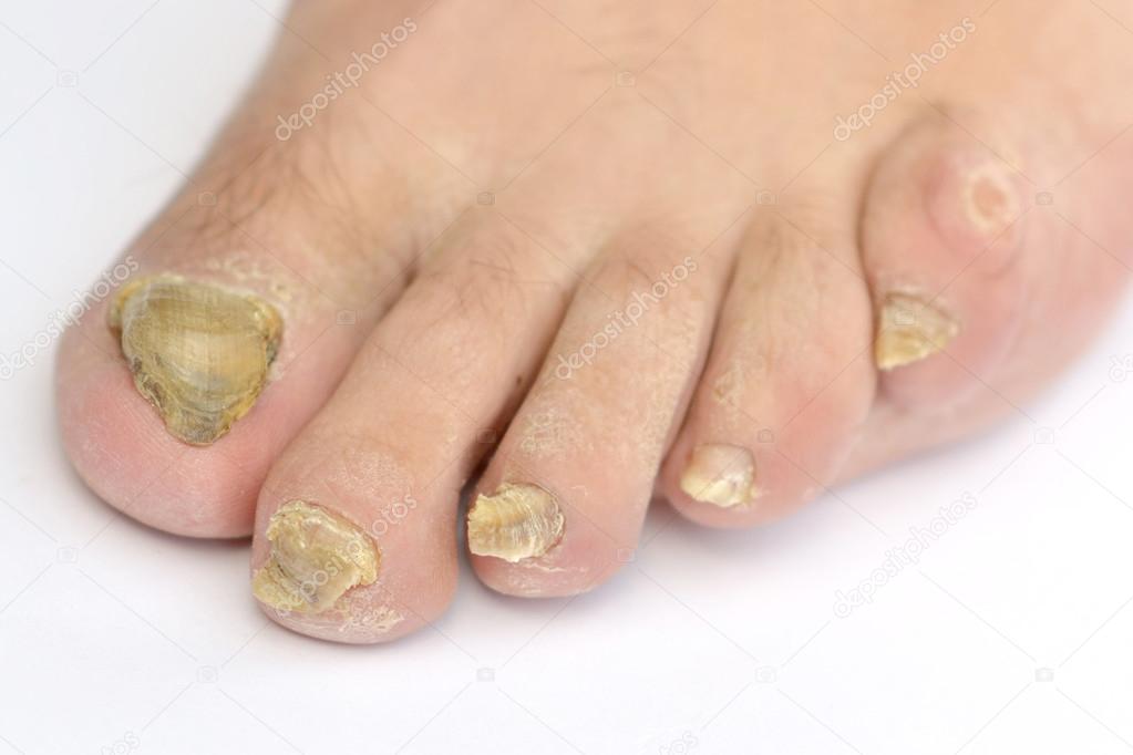 Fungus Infection on Nails