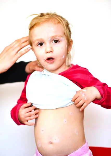 Baby girl with chicken pox rash — Stock Photo, Image