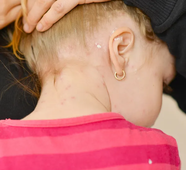 Bambina con eruzione cutanea da varicella — Foto Stock