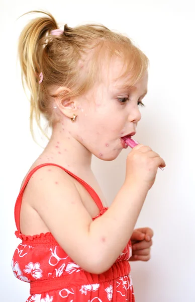 Baby girl with chicken pox rash — Stock Photo, Image