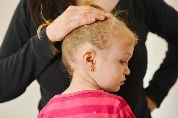 Bambina con eruzione cutanea da varicella — Foto Stock